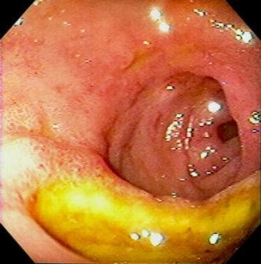 Peptic ulcer disease. Gastric cancer with an ulcer
