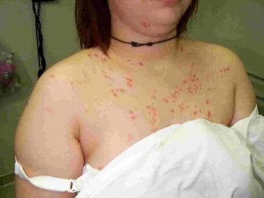 Guttate psoriasis erupted in this patient after to