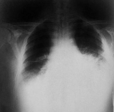 Inhalation anthrax. Chest radiograph with widened 