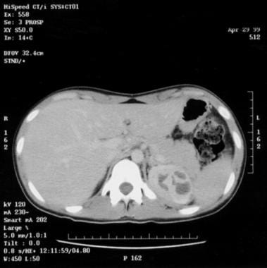 Multiple abscesses, upper pole of left kidney. 