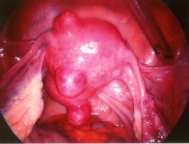 Small uterine myomas visualized at laparoscopy. 