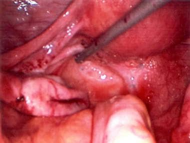 Powder-burn lesions of endometriosis. 