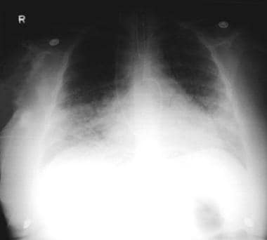 Pneumonia, viral: A 52-year-old woman developed fe