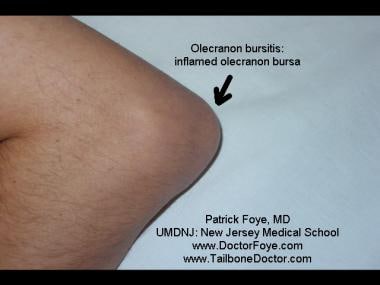 olecranon bursitis xray