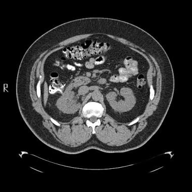 CT scan of an apparent colorenal fistula following