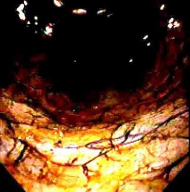 Caustic ingestions. Endoscopic view of the esophag