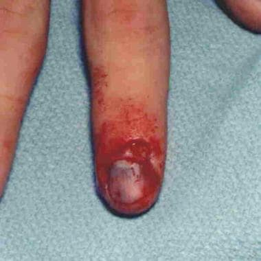 Significant nailbed injuries can occur from nail r
