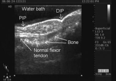 This image shows an ultrasound of the flexor tendo