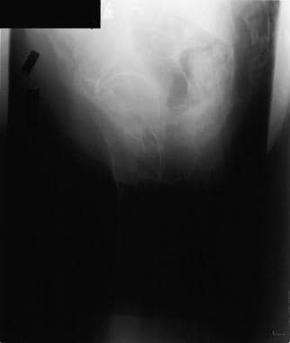 Lateral view of a Garden I femoral neck fracture. 