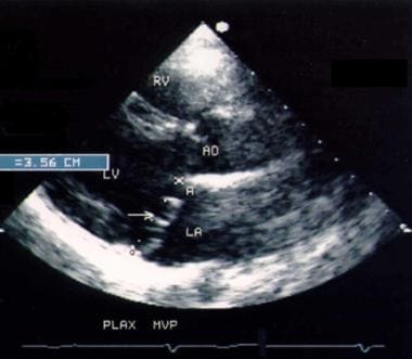 Two-dimensional echocardiographic picture taken fr