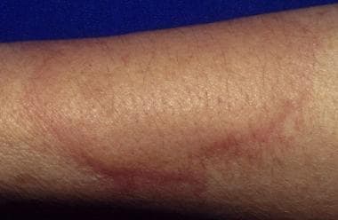 Urticaria, also known as hives or whelps, involves