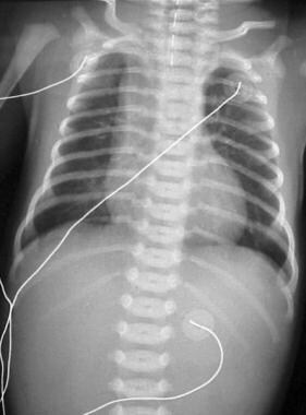Pure esophageal atresia. Newborn with tube in prox