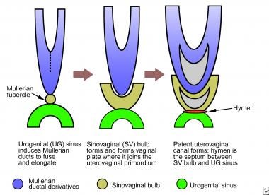 Embryologic origin of the hymenal membrane. 