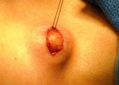 A lymph node biopsy is performed. Note that a mark
