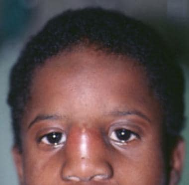 Preteenaged boy with infected nasal dermoid. A pit