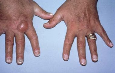 Hands of a transfusion-dependent patient on long-t