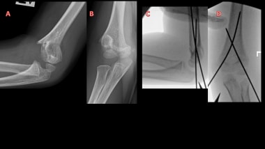 (A, B) Elbow radiographs of 5-year-old boy with ty