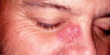 Cutaneous sarcoidosis. Violaceous papules or nodul