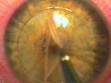 The corneal flap is lifted from the underlying str