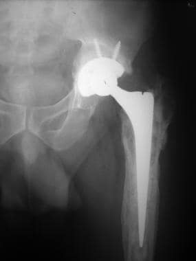Final radiograph after stage II revision. 