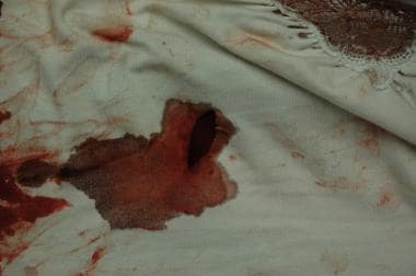 The clothing of a victim of sharp force injury sho