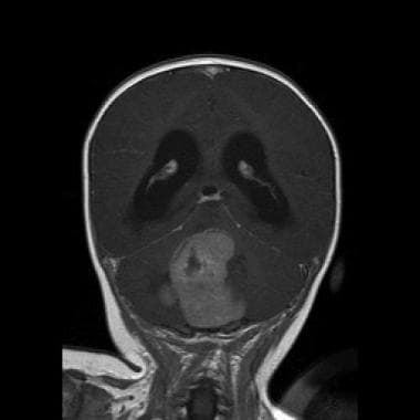 Medulloblastoma Pathology. The coronal T1 magnetic