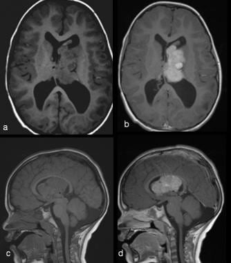 T1-weighted magnetic resonance images of a subepen