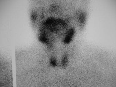 Parathyroid sestamibi scan showing ectopic parathy