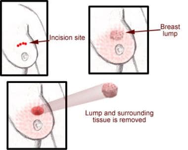 Brass after lumpectomy 