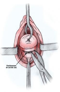 Peritoneum is incised with Mayo scissors. 