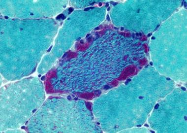 Mitochondrial myopathy, Gomori trichrome frozen se