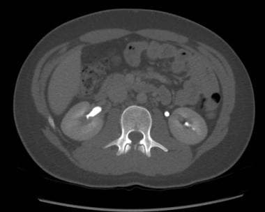 CT urogram utilizing a split dose technique: Axial