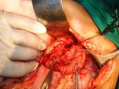 Pancreatic duct laid open adjacent to opened Roux 