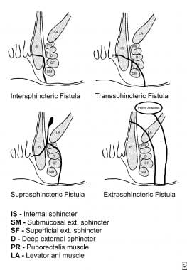 Parks classification of fistula-in-ano. 