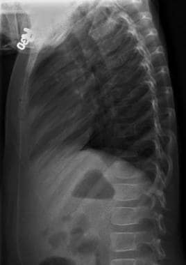 Lateral projection radiograph of child's thoracic 