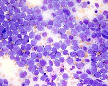 Pathology of acute myeloid leukemia not otherwise 