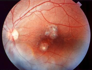 Peripapillary scars secondary to toxoplasmosis. 