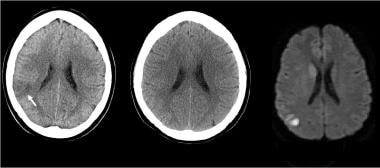 CT fogging effect: Axial noncontrast CT scan demon