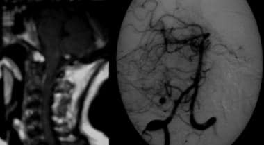 Left, T1-weighted gadolinium-enhanced MRI with an 