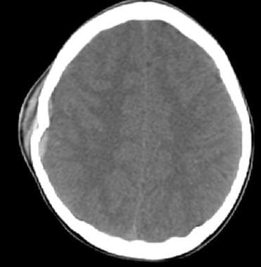 Axial head computed tomography scan shows a skull 