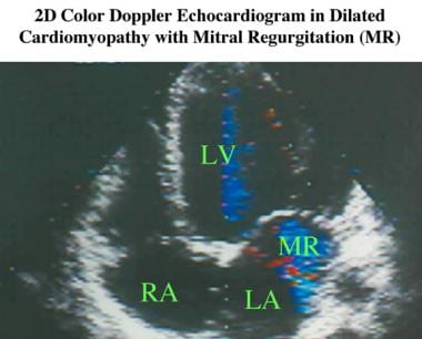 Apical 2-dimensional echocardiogram with color Dop