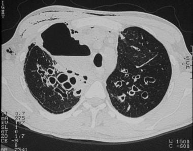 Cystic fibrosis, thoracic. High-resolution CT imag