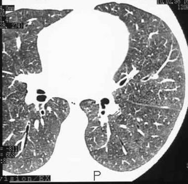 High-resolution CT (HRCT) scan in a man with a cli