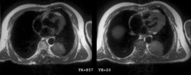T1-weighted chest magnetic resonance images show a