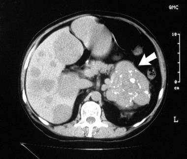 Appearance of pancreatic carcinoid. Dynamic contra