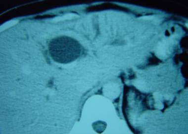 Choledochal cyst involving the intrahepatic common