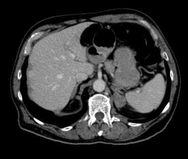 A 62-year-old man with rectal carcinoma; staging C