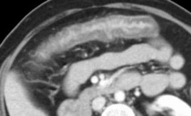 Mesenteric ischemia. CT scan in a 49-year-old woma