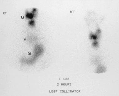Iodine-123 thyroid scan shows that a mass is a mul
