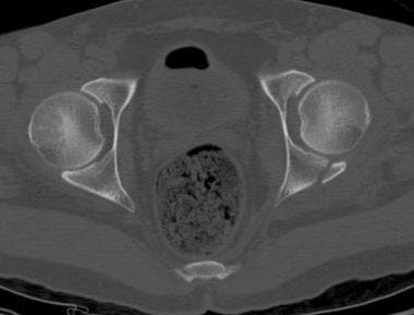 Computed tomography (CT) scan of a posterior wall 